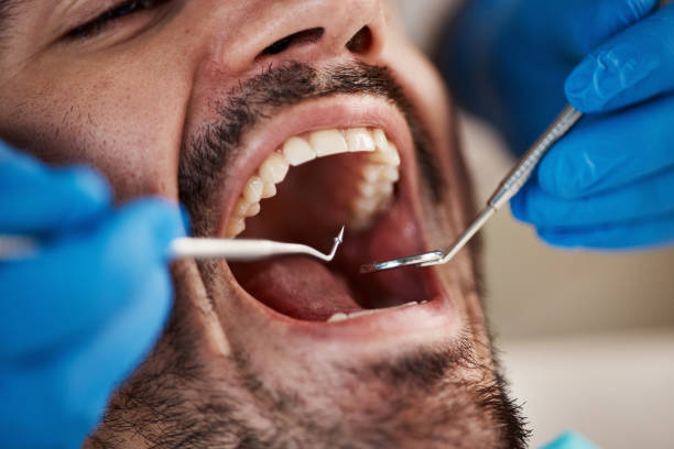 Best Emergency Dental Extractions in Atascocita, TX